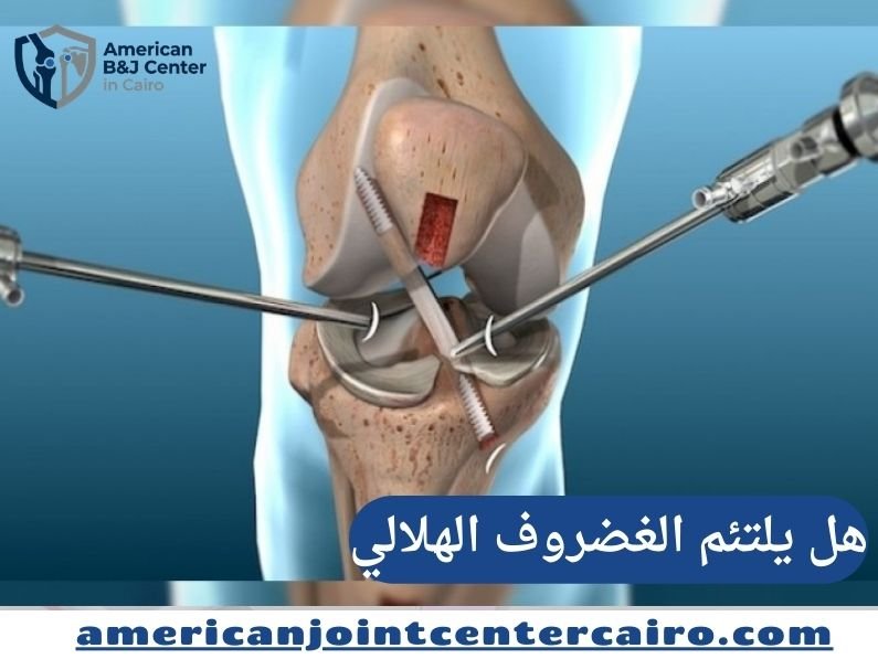 الدليل المرجعي الشامل 2026: هل يلتئم الغضروف الهلالي؟ آفاق العلاج والتعافي
