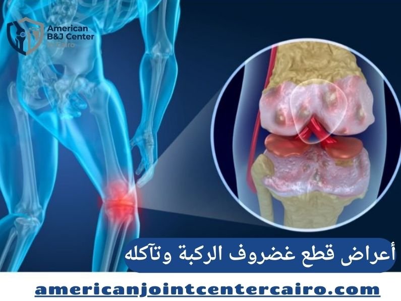 أعراض قطع غضروف الركبة وتآكله: دليل التشخيص والعلاج في المركز الأمريكي لمناظير الركبة والكتف