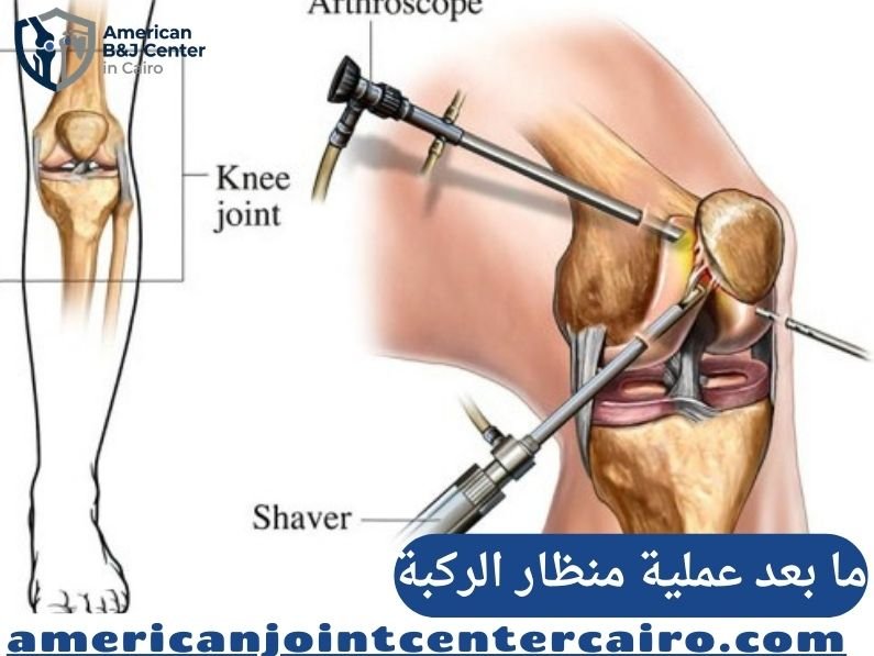 قطع الرباط الصليبي الخلفي