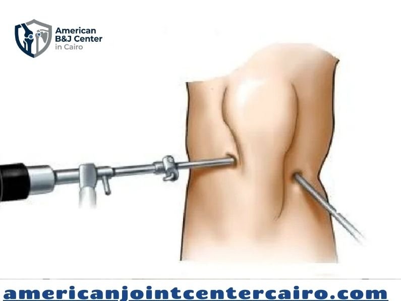 أعراض قطع غضروف الركبة وتآكله: دليل التشخيص والعلاج في المركز الأمريكي لمناظير الركبة والكتف