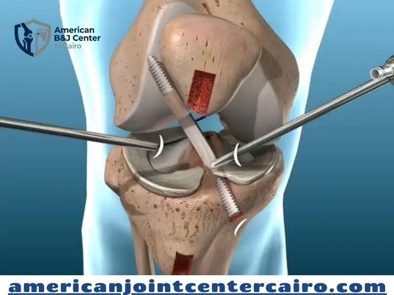أعراض قطع غضروف الركبة وتآكله: دليل التشخيص والعلاج في المركز الأمريكي لمناظير الركبة والكتف