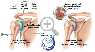 خشونة مفصل الكتف