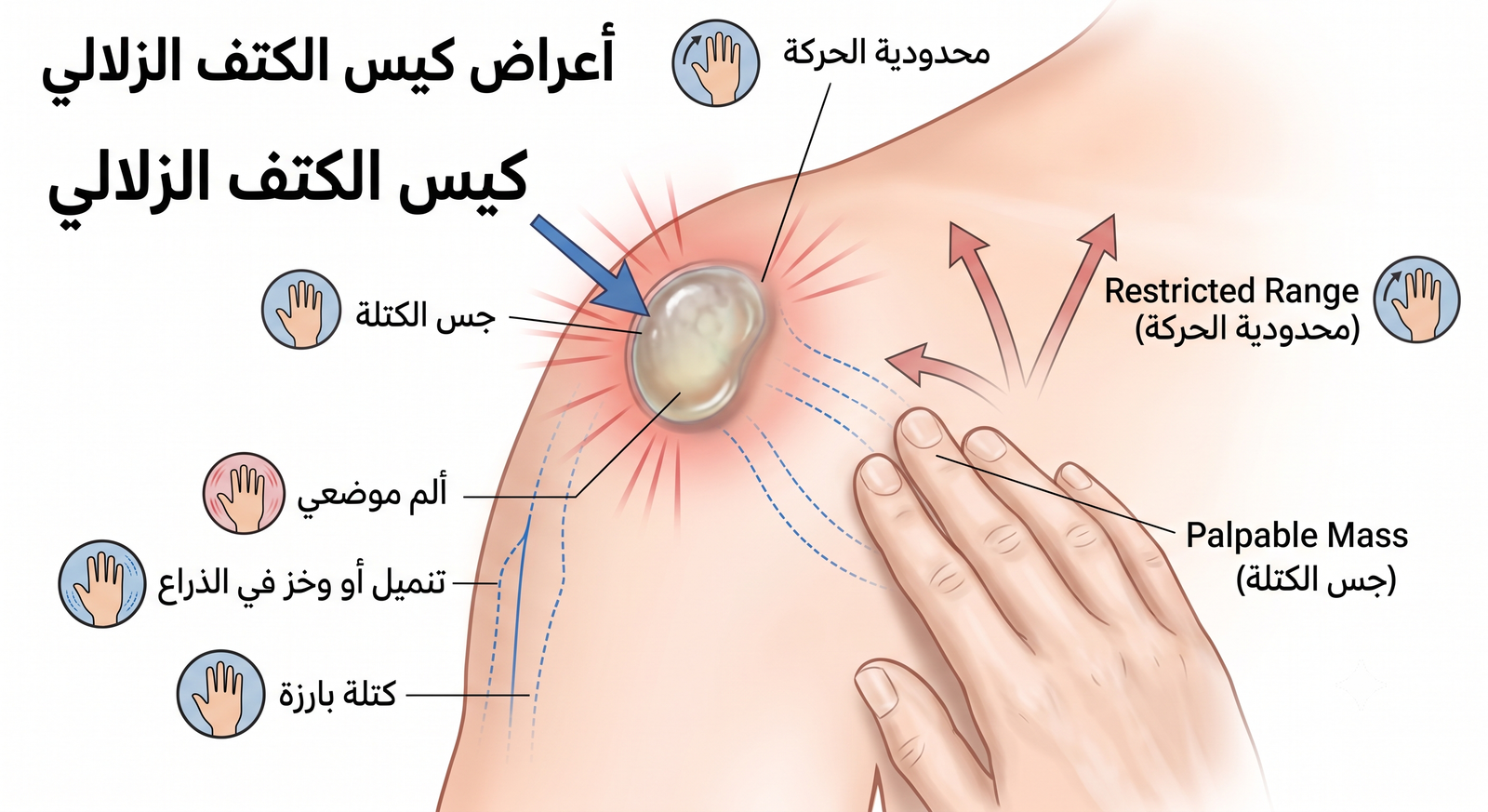 أعراض كيس الكتف الزلالي