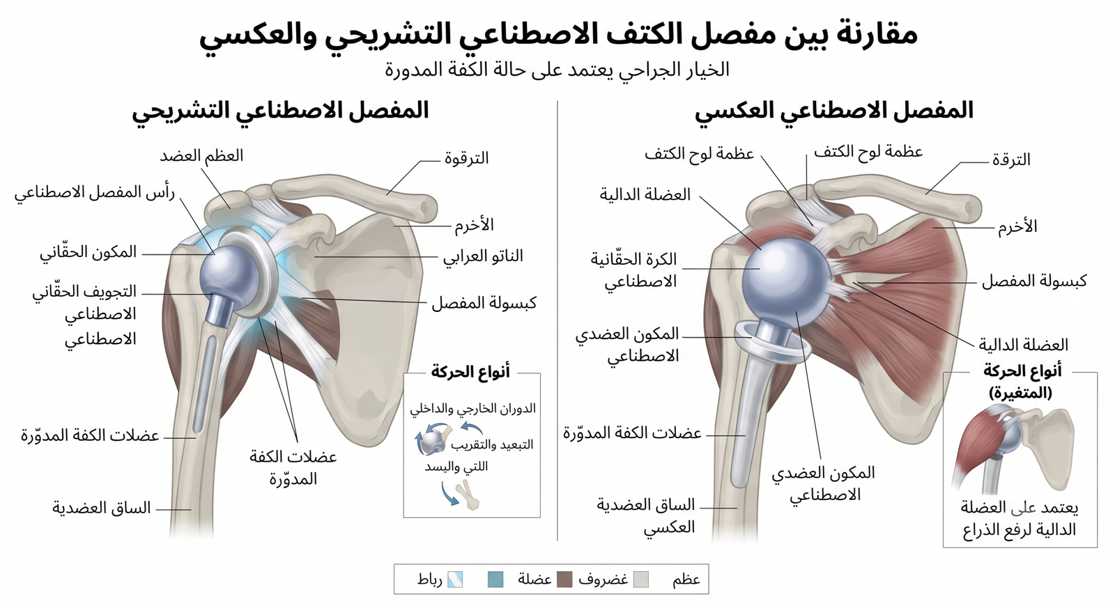 عملية تغيير مفصل الكتف