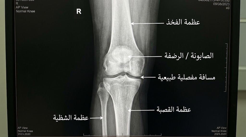 Normal Appearance of the Knee Joint on X-rays